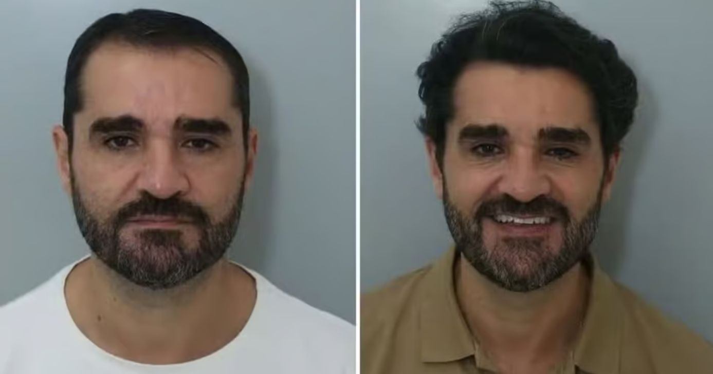 Marcelo Cosme transplante capilar.jpg